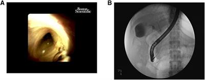 The clinical effect of a strategy called transcystic gallbladder-preserving cholecystolithotomy based on endoscopic retrograde cholangiopancreatography for cholecystolithiasis: A retrospective study from a single center